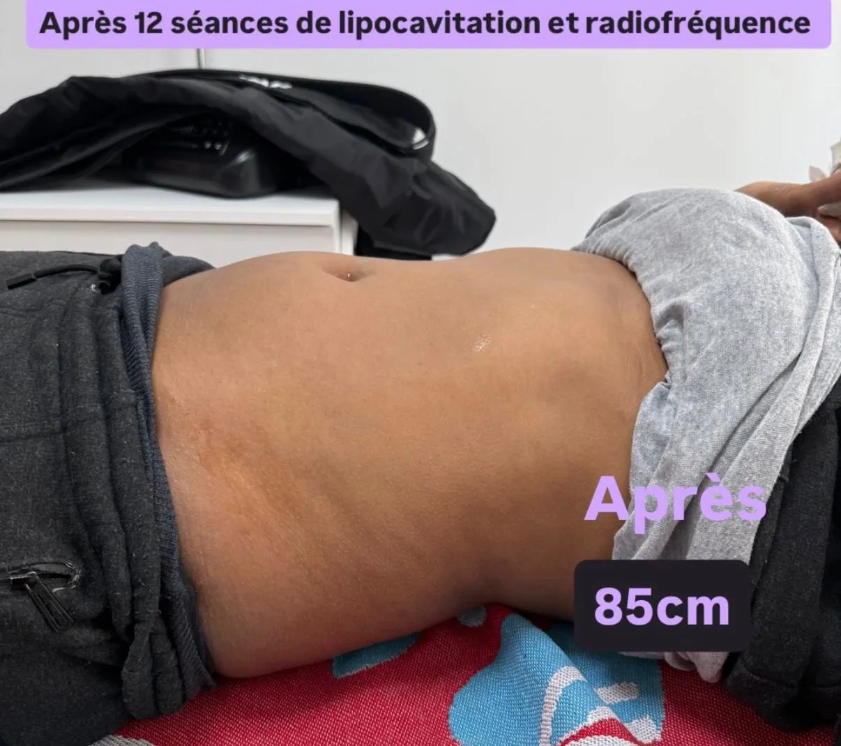 Après cure lipocavitation