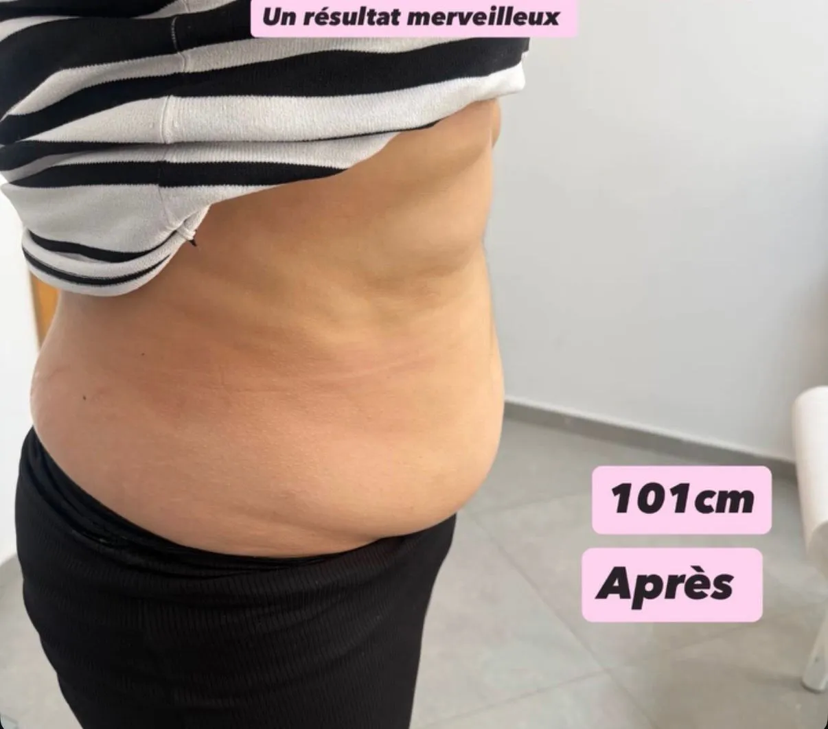 Après cure lipocavitation