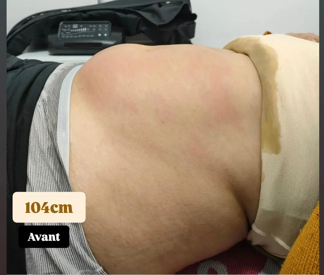 Avant cure lipocavitation