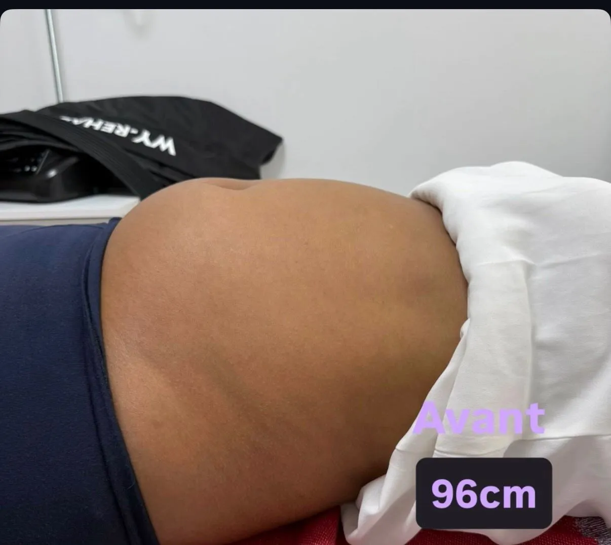 Avant cure lipocavitation