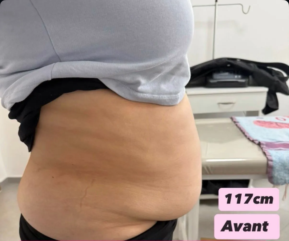 Avant cure lipocavitation